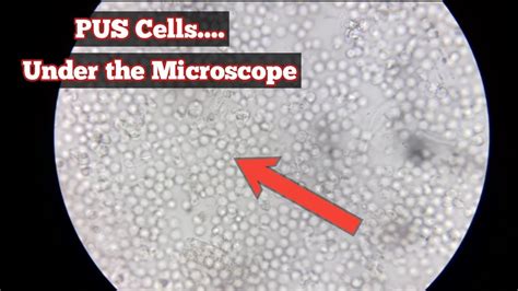 Small pearl-like balls came out of each growth, and she showed them under . . Pimple pus under microscope